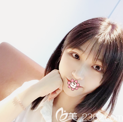 佛山華美梁宗建院長雙眼皮案例 佛山華美梁宗建院長雙眼皮案例