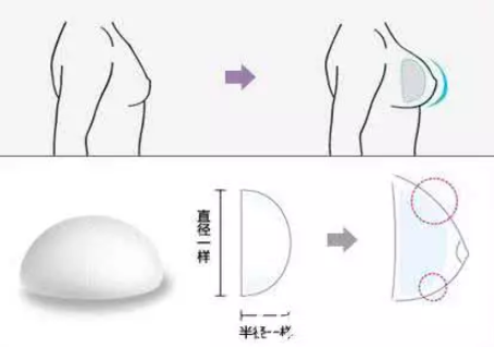 圓形假體豐胸
