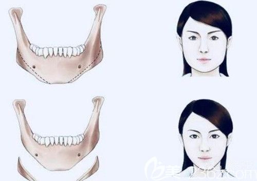 下頜角手術前后對比