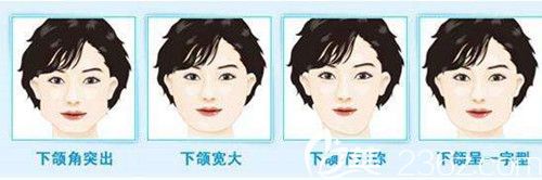 下頜角手術適合什么人群