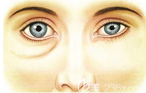 抽脂去假性眼袋效果對比