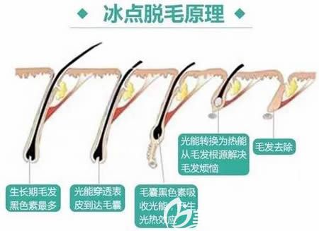 冰點(diǎn)脫毛原理介紹