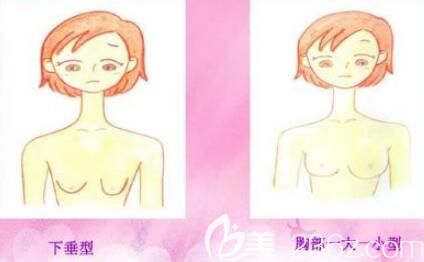 乳房下垂萎縮不對稱示意圖