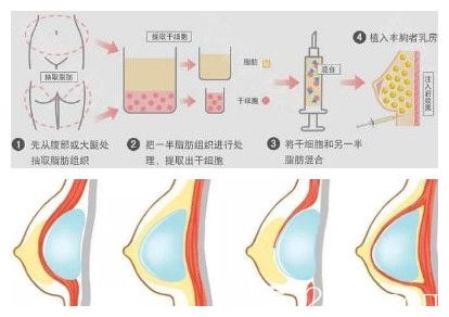 自體脂肪豐胸和假體隆胸手術(shù)示意圖