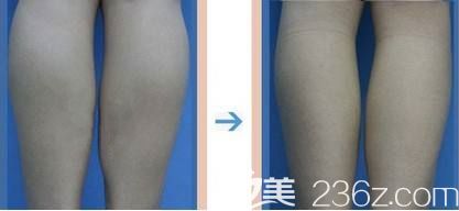 網(wǎng)友私信分享小腿抽脂術(shù)后3月無(wú)效果的對(duì)比照