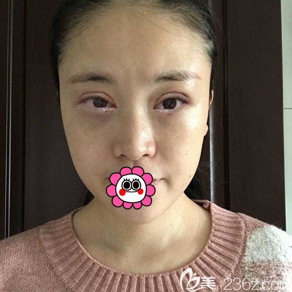 術(shù)后7天到醫(yī)院拆線前