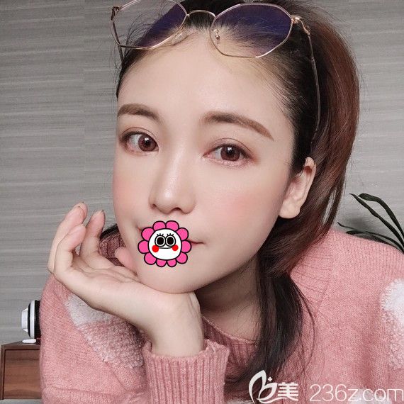 聽說溫科磊坐診杭州薇琳而且他做的雙眼皮自然靈動是真的嗎？