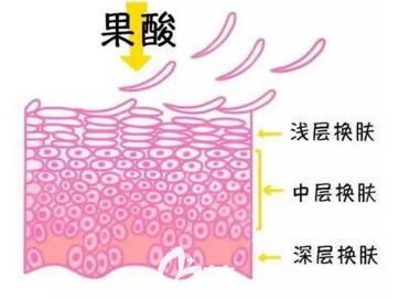 果酸煥膚的作用皮膚層