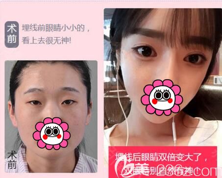 馬永奎院長(zhǎng)做埋線雙眼皮術(shù)前術(shù)后對(duì)比案例