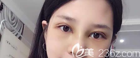 在西寧時光雙眼皮和隆鼻一起做術后第7天拆線后<span style=