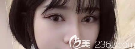 看完西寧時光整形價目表覺得劃算后我一起做了全切雙眼皮+膨體隆鼻