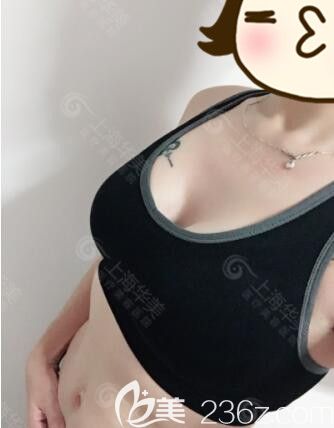 <!--<i data=20240703-sp></i>-->華美謝衛(wèi)國(guó)娜綺麗假體隆胸真人案例術(shù)后49天