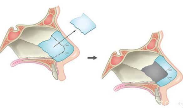 一定范圍內(nèi)取鼻中隔軟骨后鼻子不會(huì)塌陷