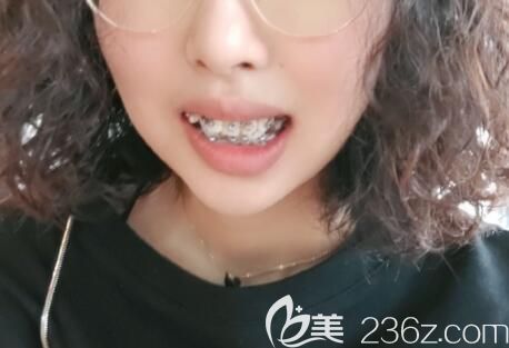 寧波恒美口腔矯正牙齒第1天 寧波恒美口腔矯正牙齒第1天