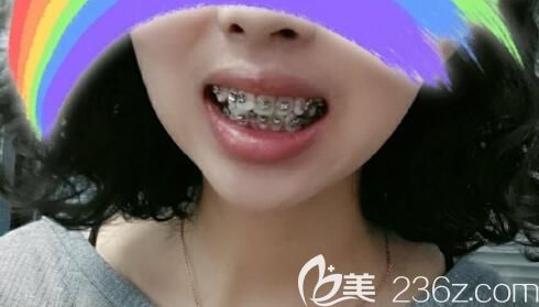 齙牙矯正第12天變化圖 齙牙矯正第12天變化圖