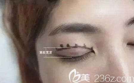 雙眼皮寬度的決定性因素介紹