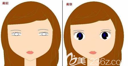 為什么有的人做了雙眼皮反而不好看的原因揭秘