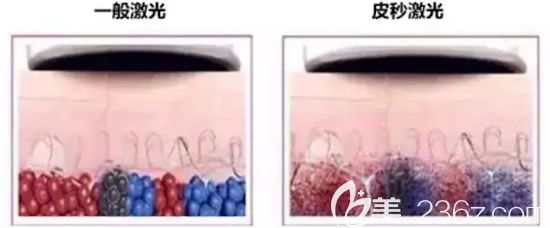 一般激光與皮秒激光的區(qū)別 一般激光與皮秒激光的區(qū)別