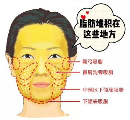 面部脂肪堆積部位