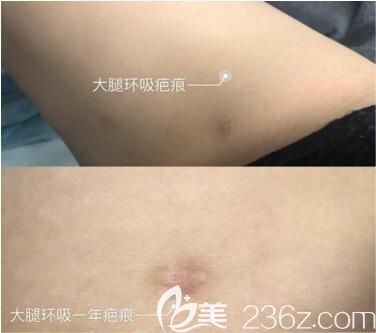 吸脂術(shù)后留下的小疤痕怎樣去除？