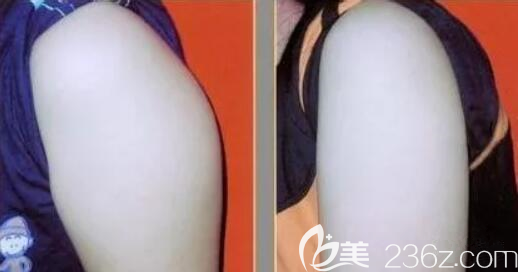 蝴蝶袖術后效果對比