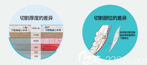 廣州韓妃整形醫(yī)院柳超磨骨優(yōu)勢 廣州韓妃整形醫(yī)院柳超磨骨優(yōu)勢