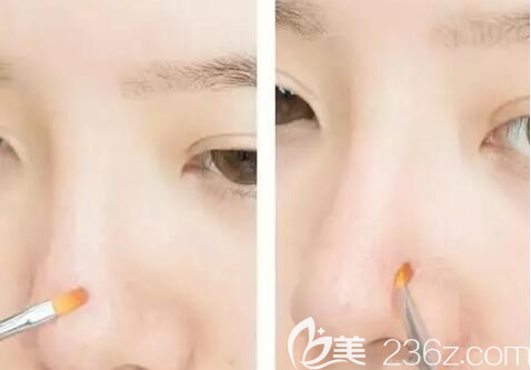 毛孔粗大小妙招