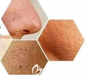 毛孔粗大像蜂窩煤一樣