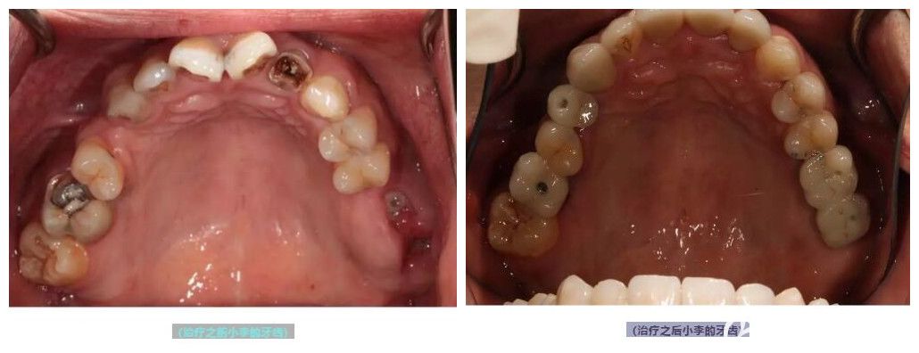 王曉勇為25歲的小李做即刻種植牙案例