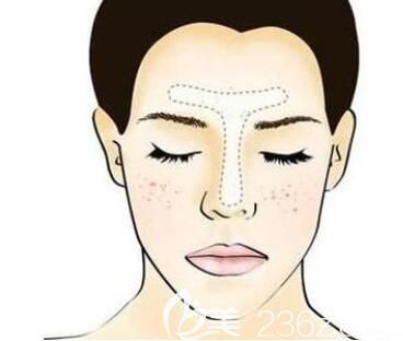 什么是老年斑？