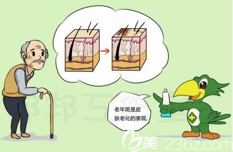 如何消除老年斑？
