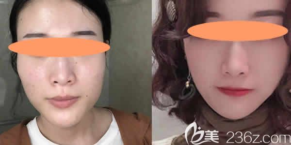 我找<!--<i data=20240703-sp></i>-->愉悅美聯(lián)臣找<!--<i data=20240703-sp></i>-->院長做削下頜骨<span style=