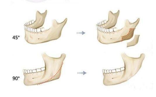 磨骨會(huì)導(dǎo)致皮膚下垂嗎的相關(guān)介紹