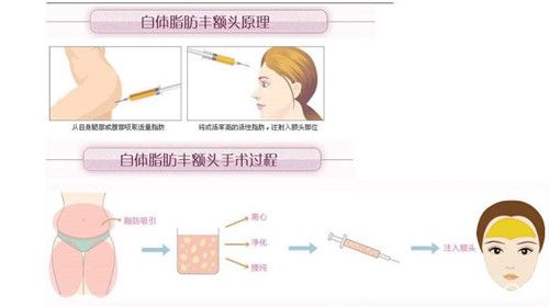 自體脂肪豐額頭示意圖