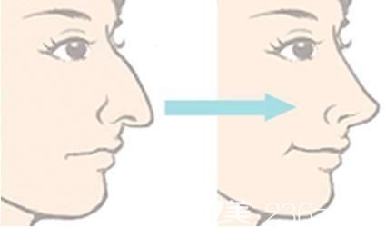 鷹鉤鼻矯正方法