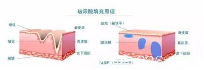 玻尿酸填充原理