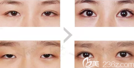 上瞼下垂矯正案例