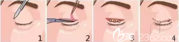 額肌瓣懸吊術(shù)圖解