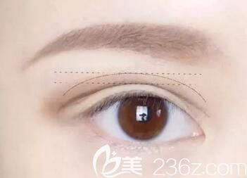 雙眼皮后出現(xiàn)疤痕增生該怎么辦？