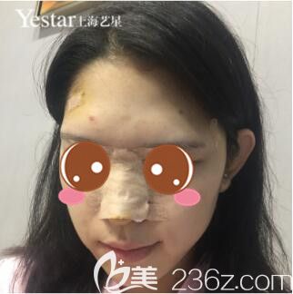 <!--<i data=20240703-sp></i>-->藝星李建兵YS立挺鼻整形真人案例術(shù)后第3天