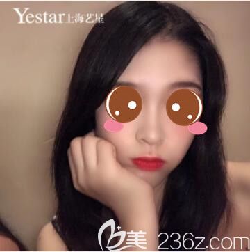 <!--<i data=20240703-sp></i>-->藝星李建兵YS立挺鼻整形真人案例術(shù)后33天