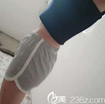 泉州脂管加邵起民醫(yī)生為腰腹吸脂術(shù)后一個(gè)月照片 泉州脂管加邵起民醫(yī)生為腰腹吸脂術(shù)后一個(gè)月照片