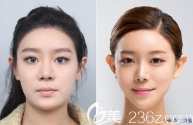 韓國<!--<i data=20240703-sp></li>
?
<li><i data=20240703-sp></i>-->院長面部輪廓整形<span style=