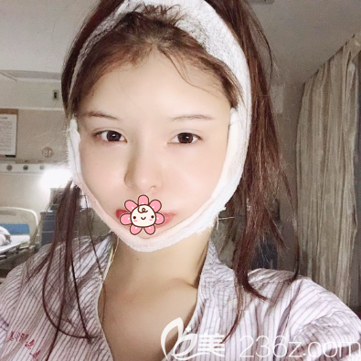 下頜角磨骨術(shù)后7天恢復(fù)效果圖 下頜角磨骨術(shù)后7天恢復(fù)效果圖