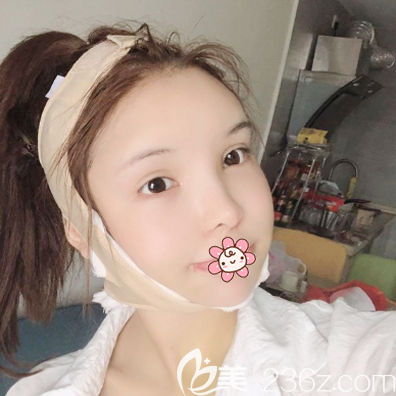 徐威強磨骨案例術(shù)后15天效果圖 徐威強磨骨案例術(shù)后15天效果圖