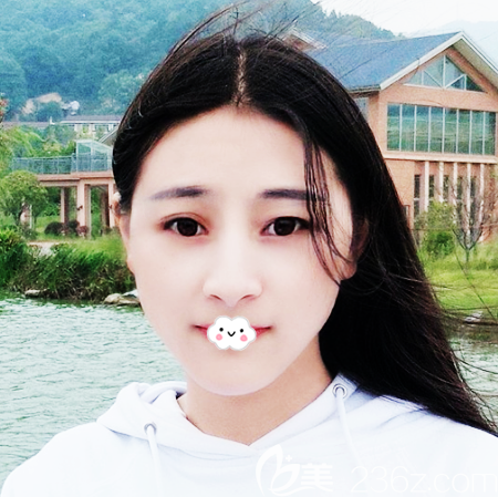 看到朋友找廣州廣大醫(yī)院做的磨骨案例效果那么好我也去做了削下頜角手術(shù)