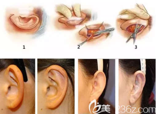 招風耳治療圖解和效果