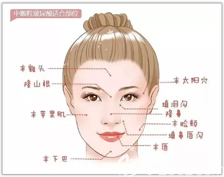 中分子玻尿酸適合填充部位