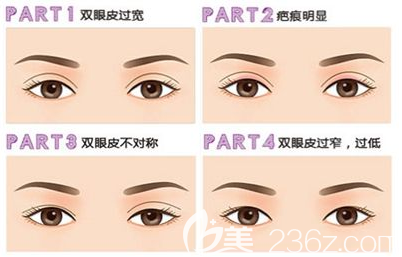 雙眼皮失敗的幾種類型