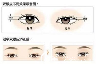 雙眼皮不同效果示意圖